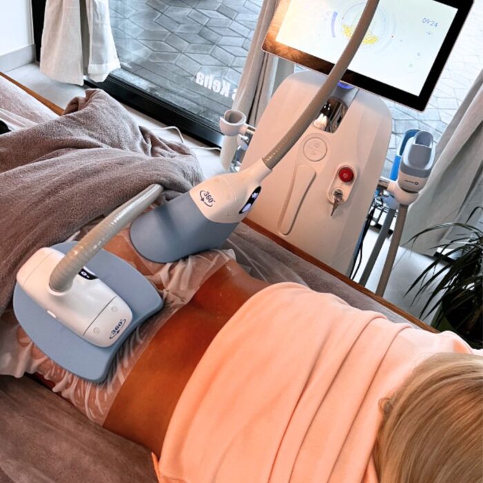 cryolipolysis_kruolipoluus