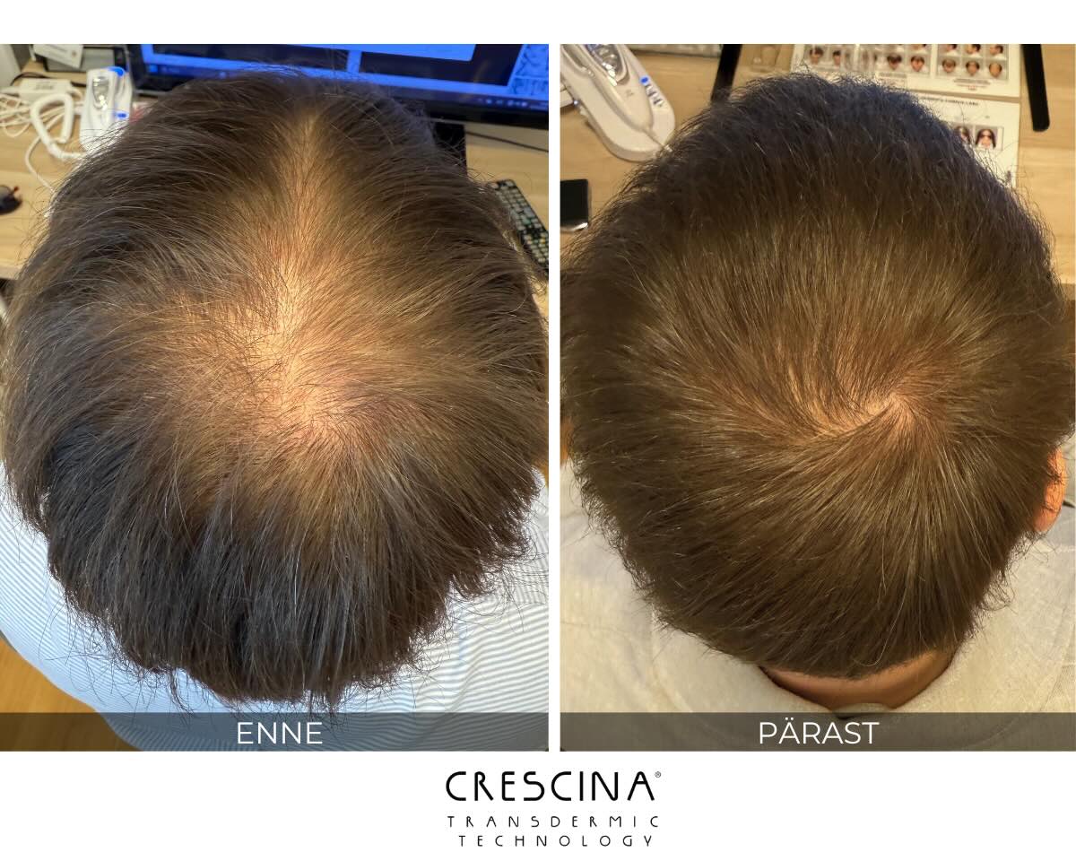 crescina tulemus ants rootslane crescina tulemus ants rootslane