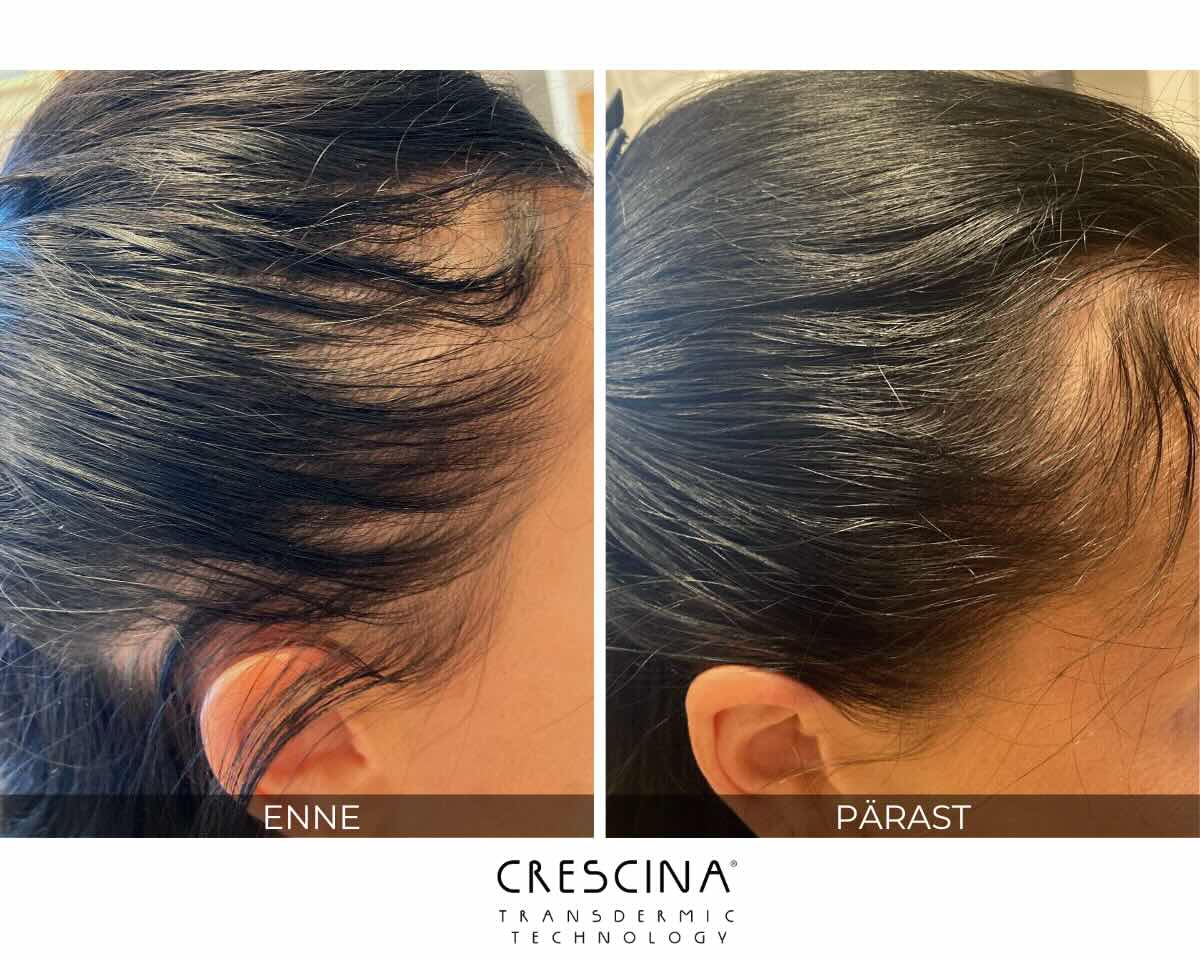 crescina-tulemus-naised crescina-tulemus-naised