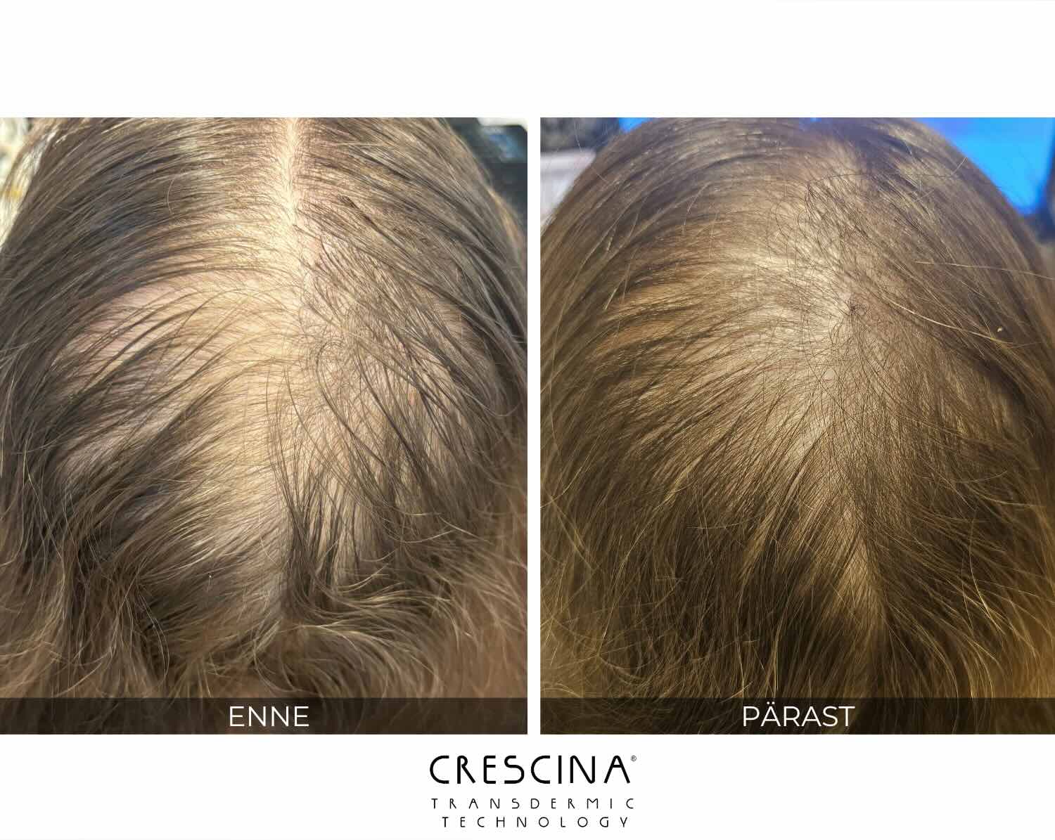 crescina_enne_parast_tulemused_triin crescina_enne_parast_tulemused_triin